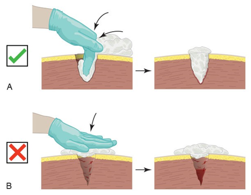 The right and wrong ways to pack a wound with gauze